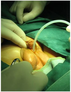 尿道下裂矫正成形术